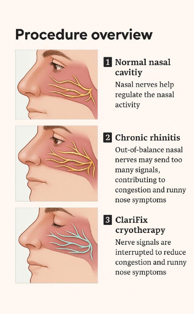 Chronic Rhinitis - Tennessee Breathe Free